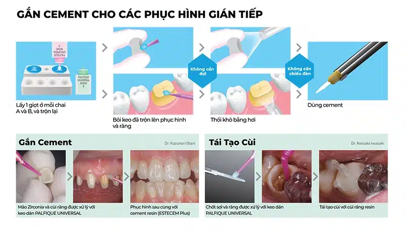 Gắn Cement cho các phục hình gián tiếp Palfique Universal Bond