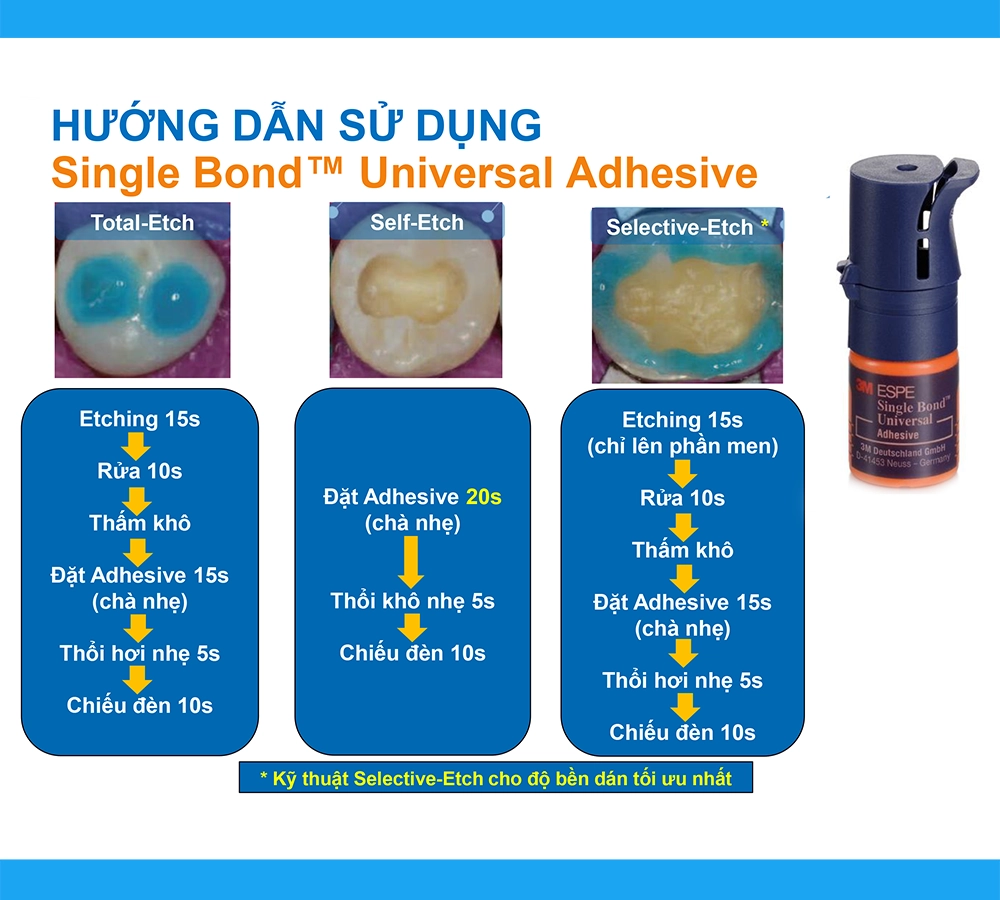 sử dụng Single Bond Universal Adhesive